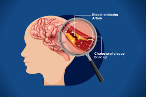 Gestione di Stroke Ischemic Stroke